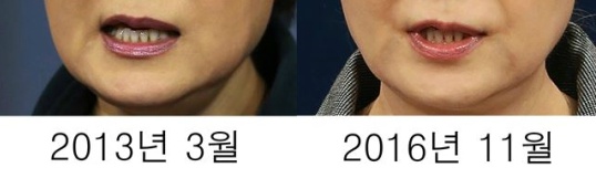헬반도의 흔한 시술 중독자 | 인스티즈