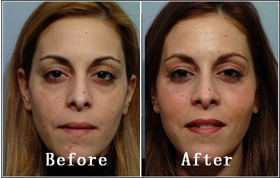 미국에서 은근히 많이하는 성형수술 세가지 | 인스티즈