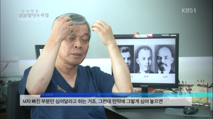 모발이식수술의 이면 | 인스티즈
